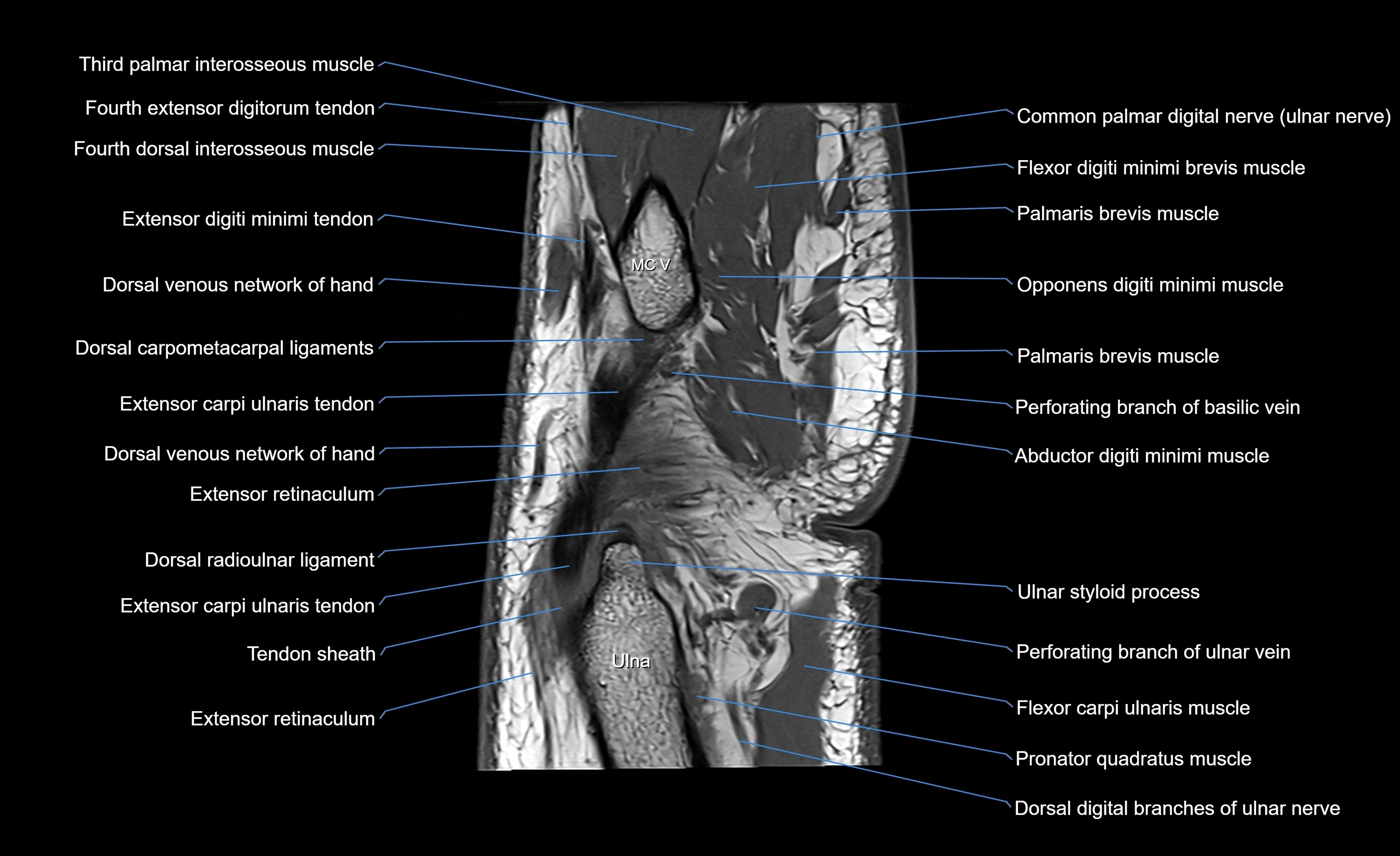 MRI wrist sagittal cross sectional anatomy 3T  radiology  image-img-00001-00022.webp